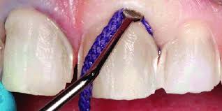 Retraction Cord Ultradent