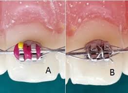 Orthodontic Bracket Ligatures