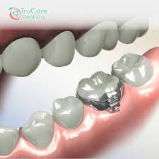 Orthodontic Molar Band