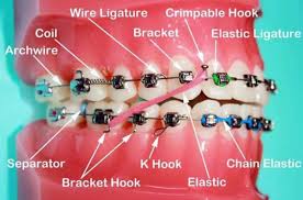 Orthodontic Bracket Ligatures