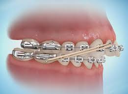 Elastics