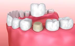 Temporary Crowns