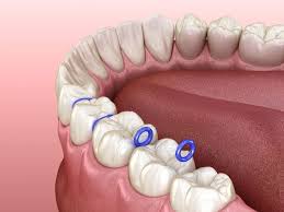 Orthodontic Separator