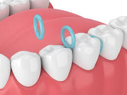 Orthodontic Separator