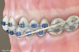 Elastics