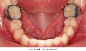 Orthodontic Molar Band