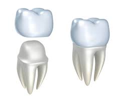 Temporary Crowns